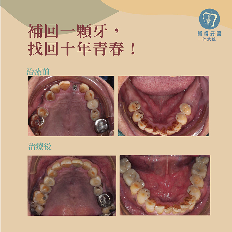新悅美學牙醫-戚先生的補牙回春記的第2張圖片
